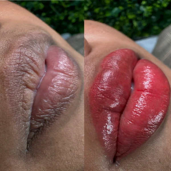 lip neutralization price melbourne