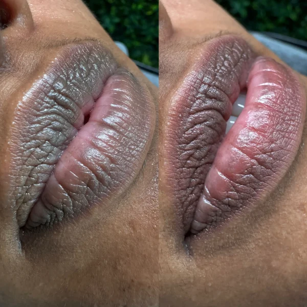 lip neutralizing melbourne