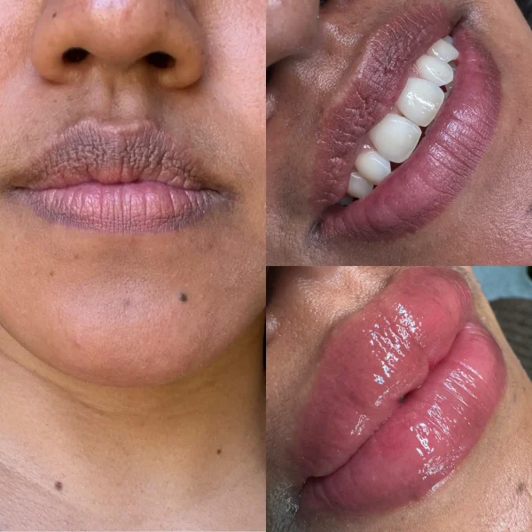 lip tattoo neutralization melbourne