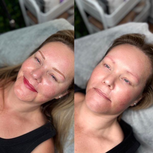 lip tattoo treatment Brisbane