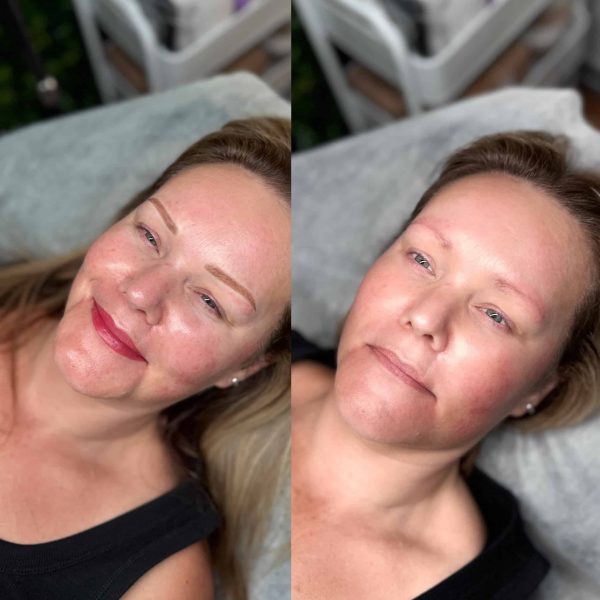 lip tattoo treatment Brisbane