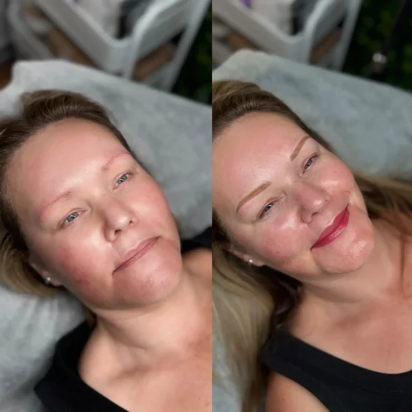lip tattoo treatment