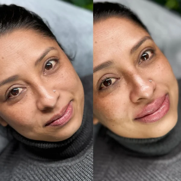 lips neutralization in melbourne