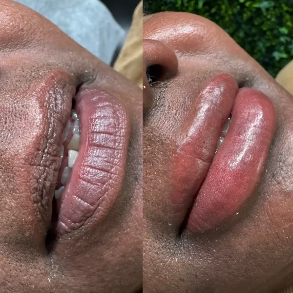 lips neutralization near me