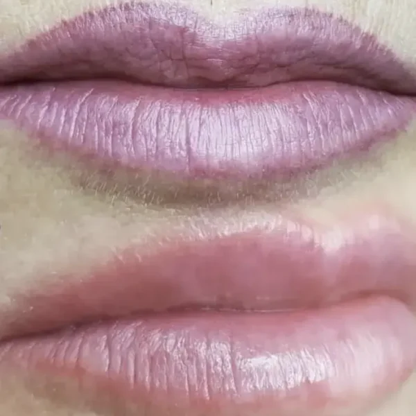 permanent makeup removal laser
