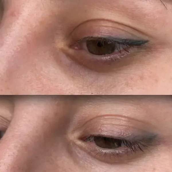 permanent makeup removal near me