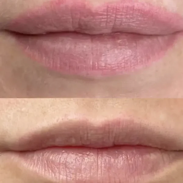 permanent makeup removal