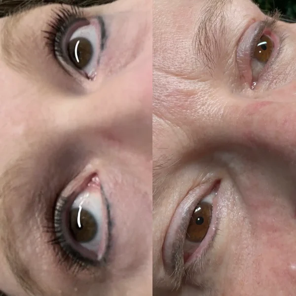 permanent makeup tattoo removal