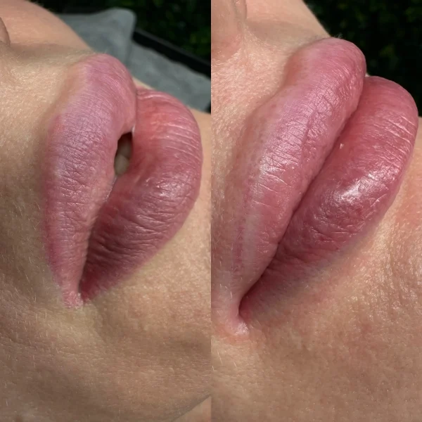removing cosmetic tattooing