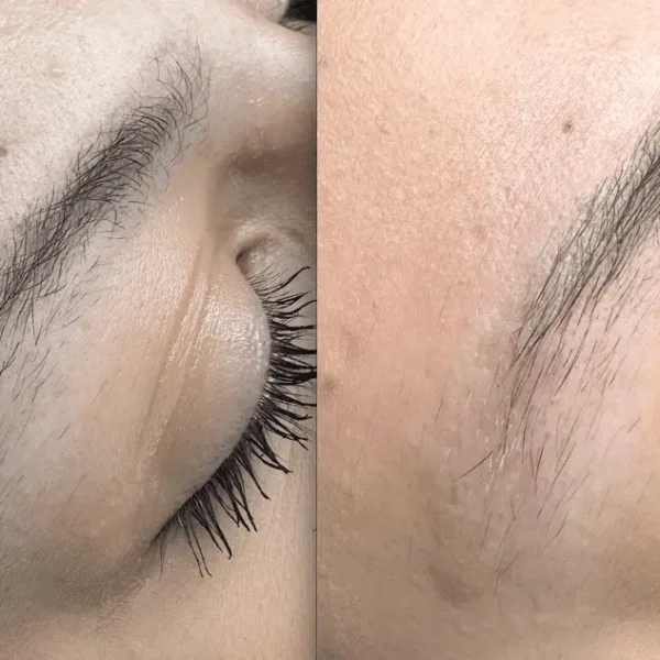 removing eyebrow tattoo