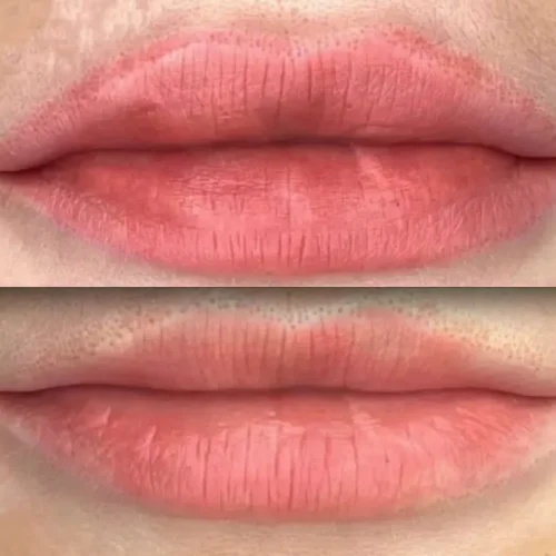 saline brow tattoo removal