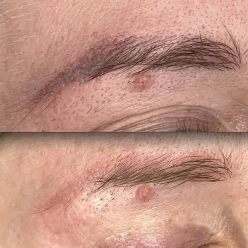 saline eyebrow tattoo removal