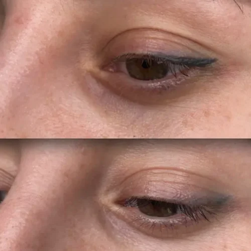 saline eyebrow tattoo removal before and after