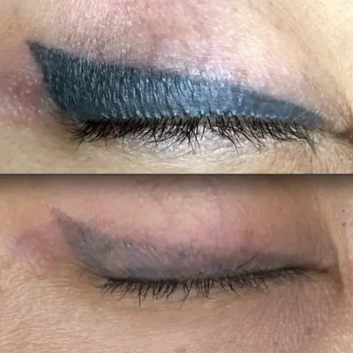 saline tattoo removal aftercare