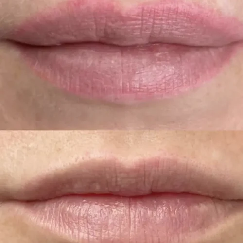 saline tattoo removal before and after