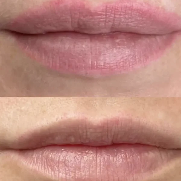 saline tattoo removal before and after