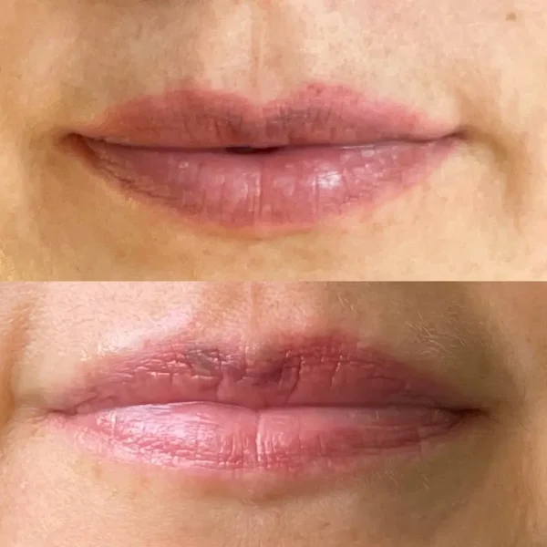 saline tattoo removal melbourne