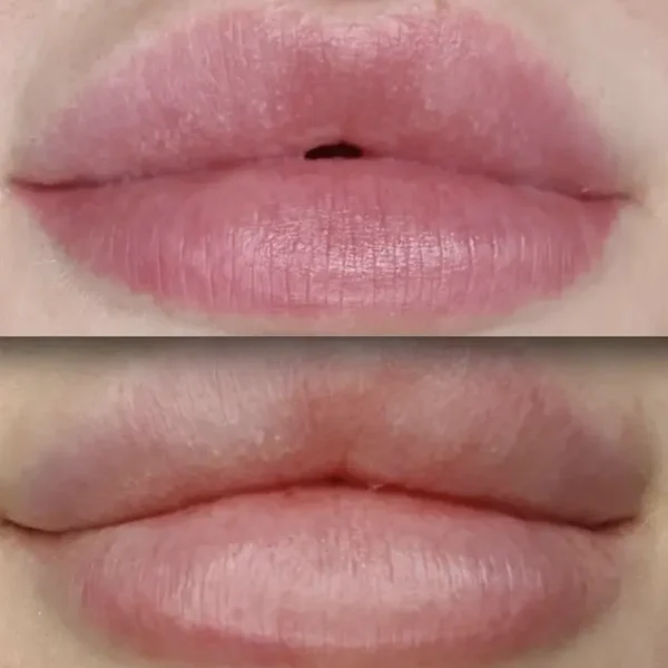 salt and saline tattoo removal before and after