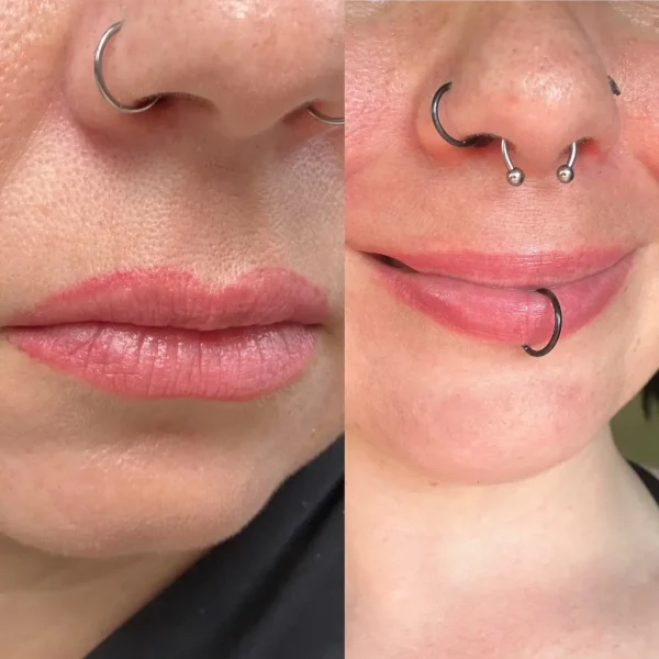 tattoo removal saline