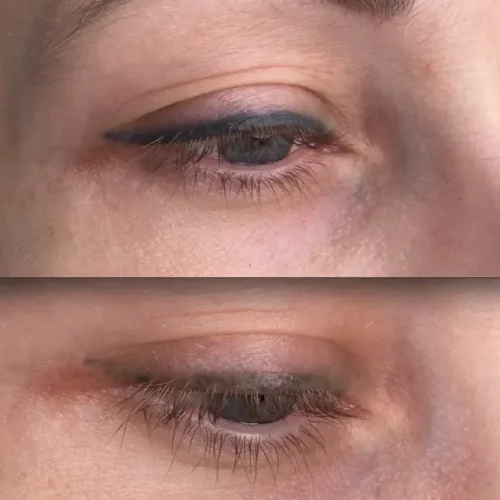 tattoo removal solution