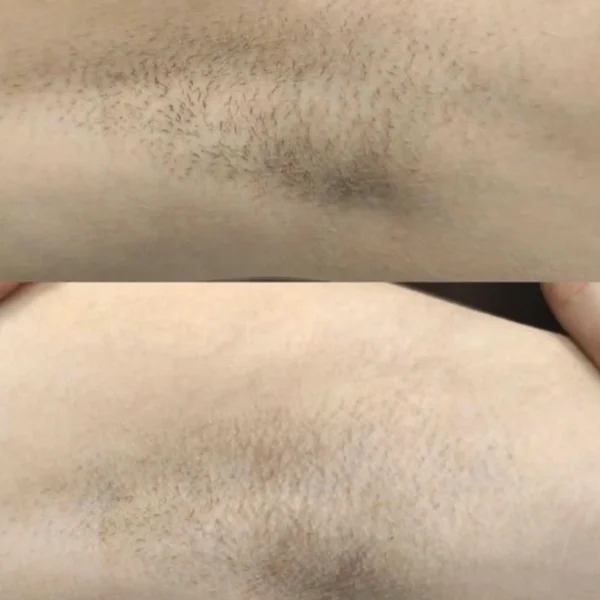 women's full body laser hair removal