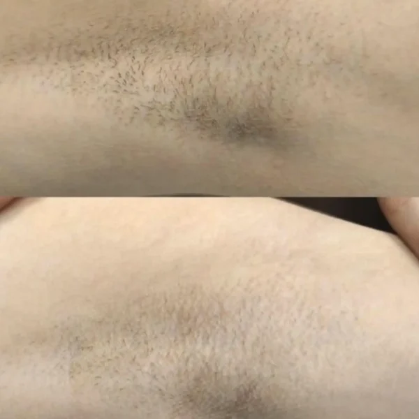 women's full body laser hair removal